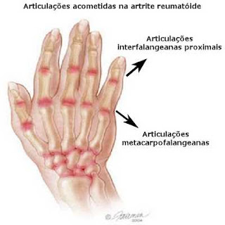 Artrite reumatóide