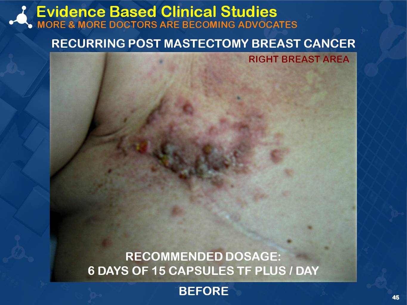 cancer patient transfer factor