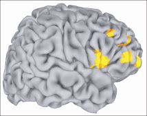 9.22J / HST.422J A Clinical Approach to the Human Brain Fall 2006