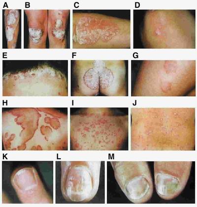 Como curar la psoriasis por las hierbas