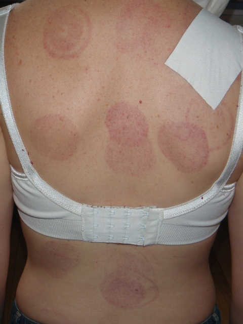 [cuppingbruises.JPG]