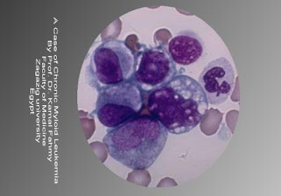 اطلس علم الدم -1- Chronic+Myeloid+Leukemia