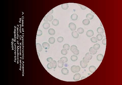 اطلس علم الدم -1- Hypochromic+Anemia