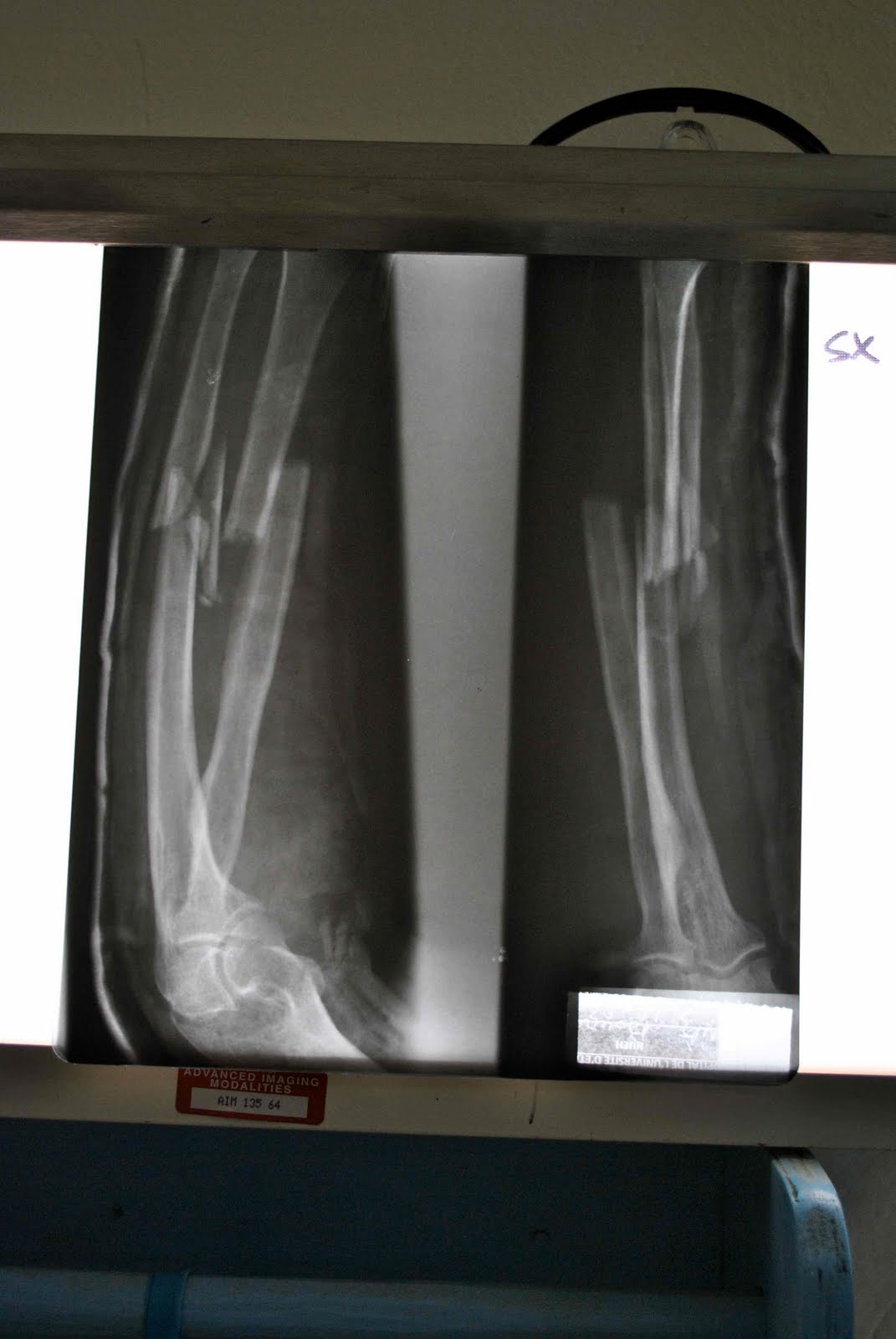 [both+bone+forearm+fracture+xray.jpg]