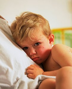 chicken pox measles
