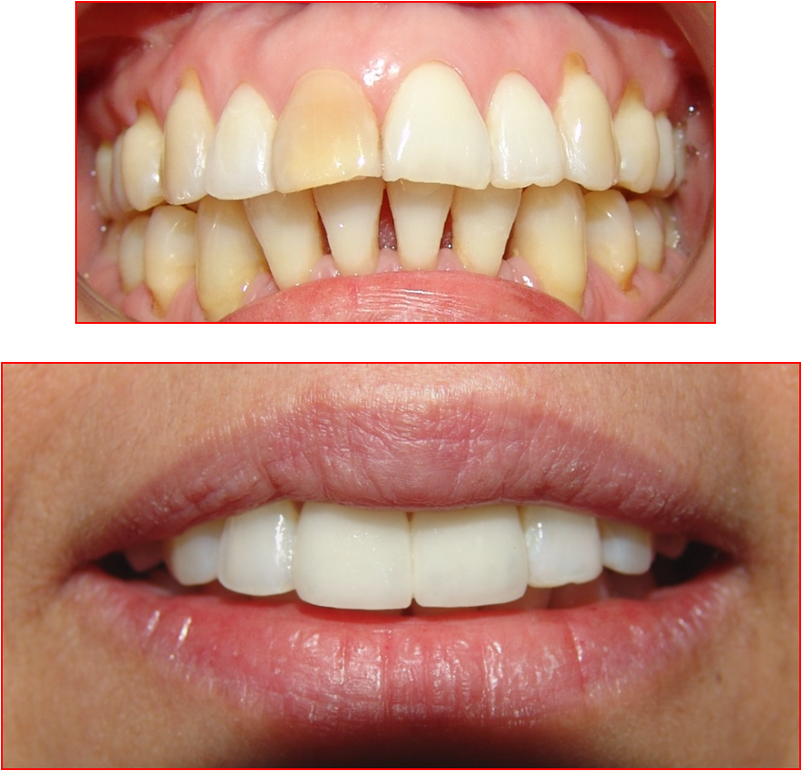 Diferencias entre carillas dentales de porcelana y de composite