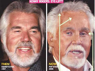 kenny rogers face lift
