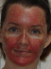 peeling forehead