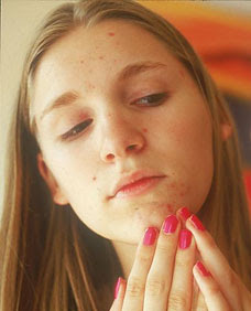 acne-cream.jpg