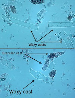 تحليل البول (4) Waxy+casts
