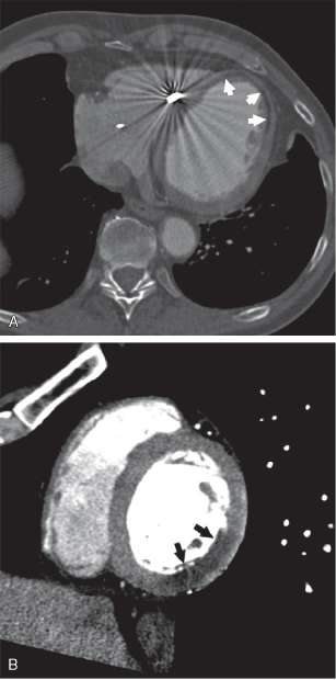 cardiac ct angiography radiopaedia