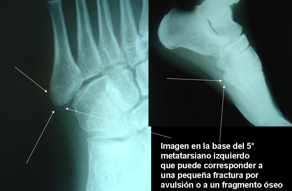 Traumatología Deportiva Infantil FRACTURAS DEL QUINTO METATARSIANO EN