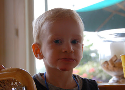 Scraped Chin