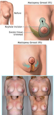 breast lift, mastopexy