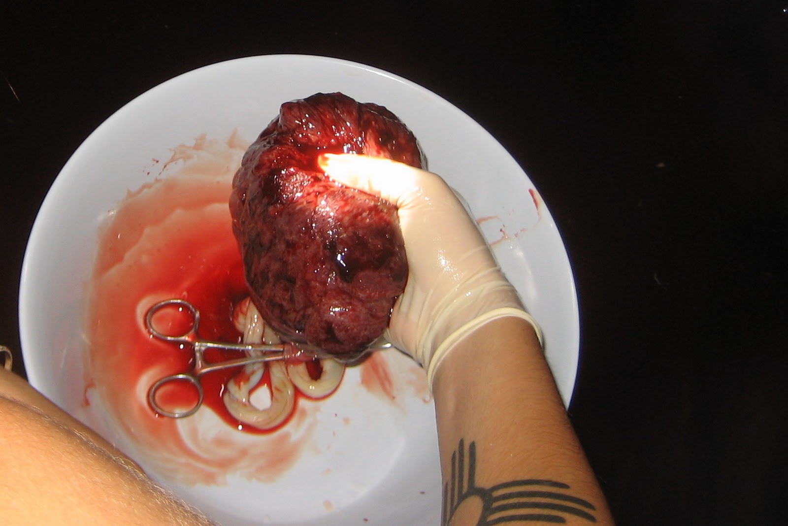 Placenta Position
