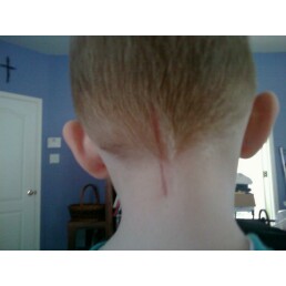 Another battle wound...this one from his Chiari malformation brain surgery.