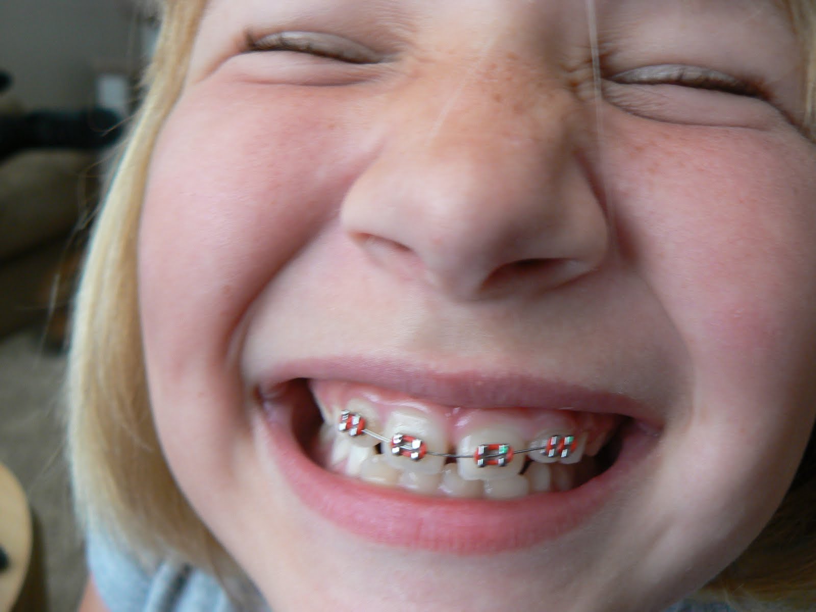 My Life in 365 Photos Day 108 Chloe with New Braces