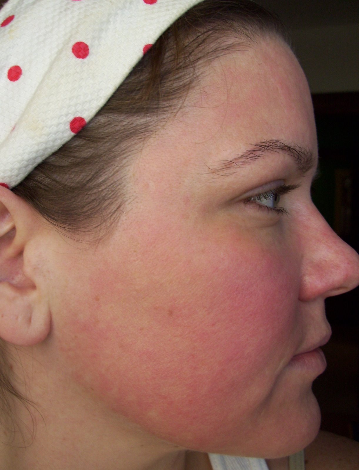 [Post+Pearl+Day+8+Cheek+Chin.JPG]