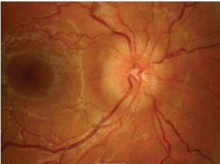 Pseudotumor Cerebri