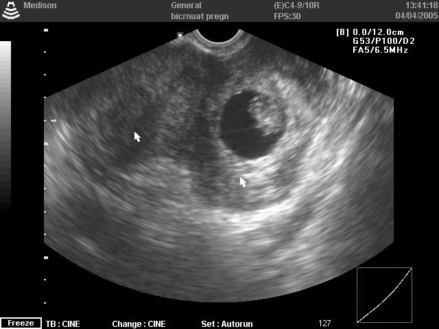Pregnancy in bicornuate uterus