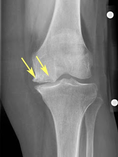 knee osteonecrosis spontaneous subchondral sclerosis lucency radiology joint lateral condyle femoral normal