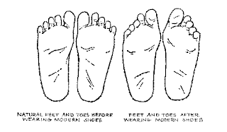 Acquired Flat Foot