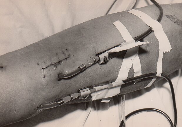 [Hemodialysis+Experimental+Artificial+Kidney+VAH+Hospital+Bronx+NY+9-9-1964.JPG]