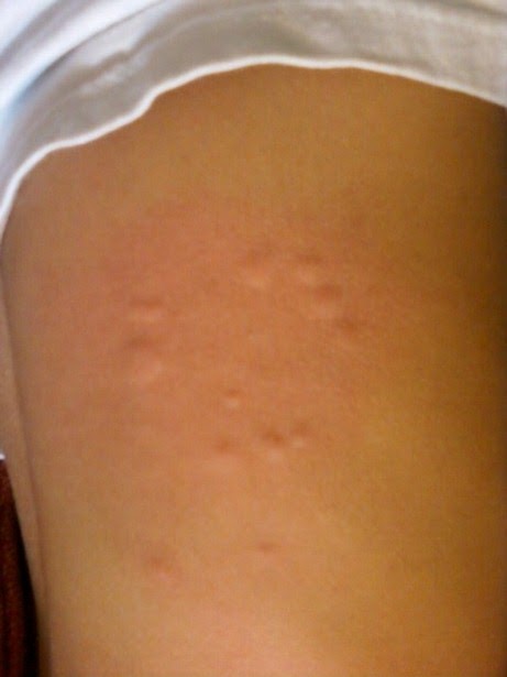 `: More Mysterious Bites!