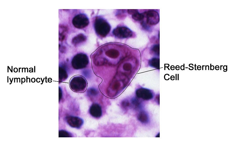 Medic Guide What are ReedSternberg cells?