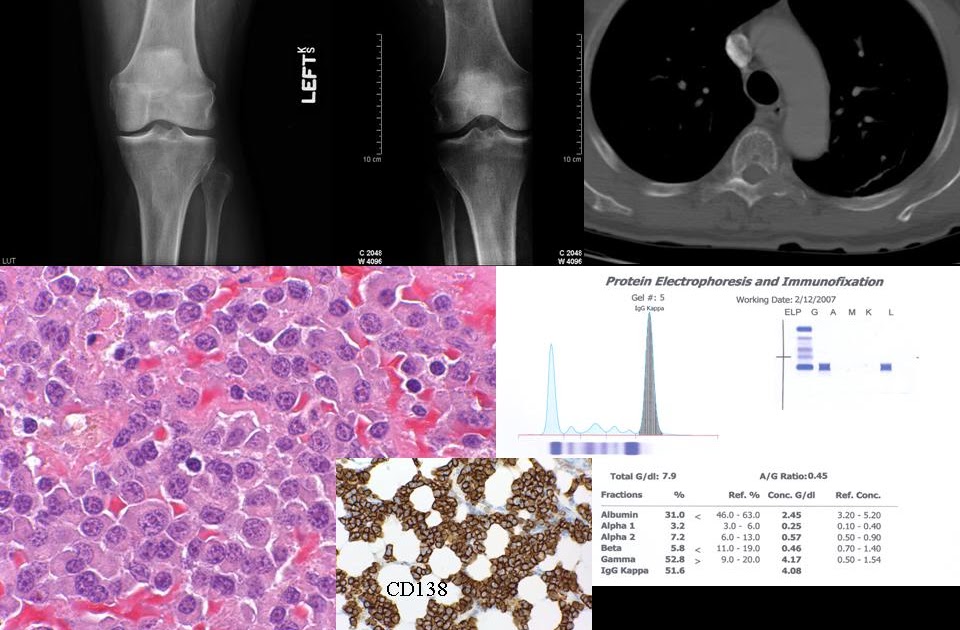 University of Toledo Radiology Multiple Myeloma