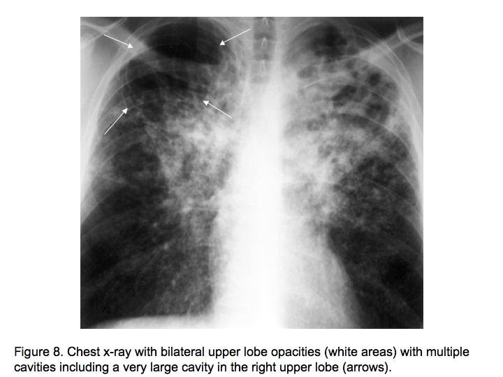 Anatomy and Physiology Tuberculosis DIAGNOSIS
