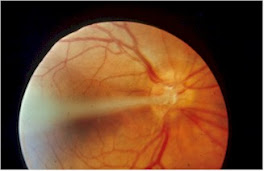 PHPV in the eye