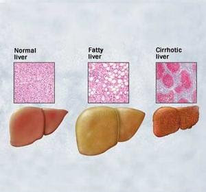 سرطان الكبد Liver+problems2