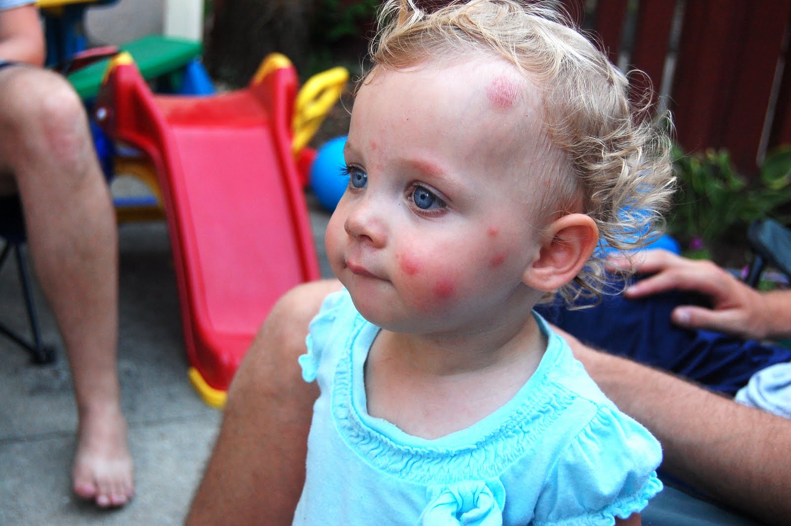 Bug Bite Lip