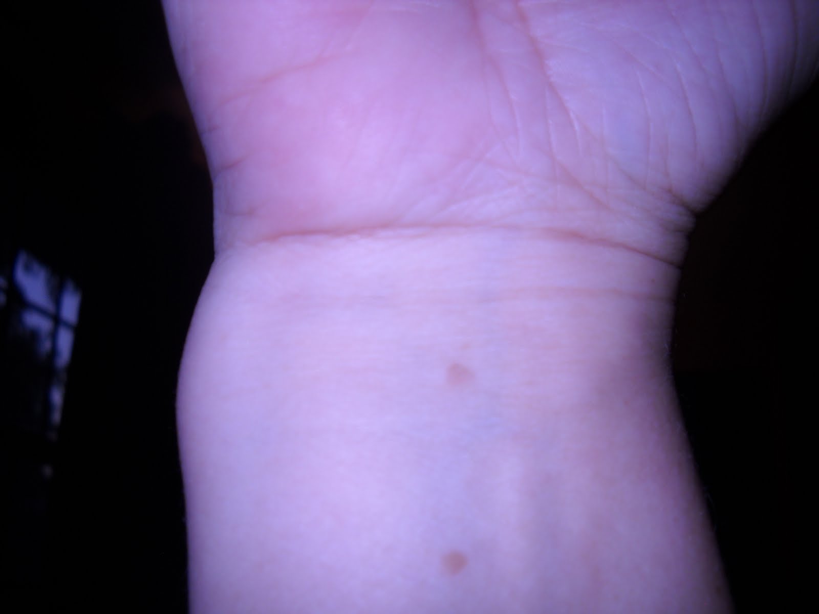 Wrist Lump