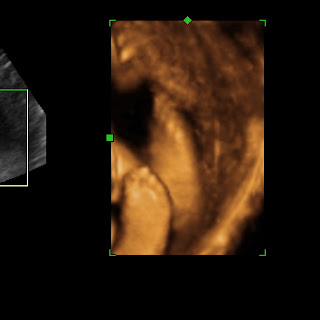3d ultrasound pictures at 24 weeks pregnant 3d ultrasound pictures at 24 weeks pregnant