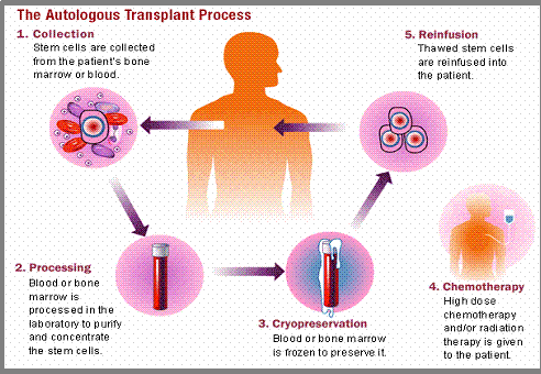 bone marrow transplant procedure