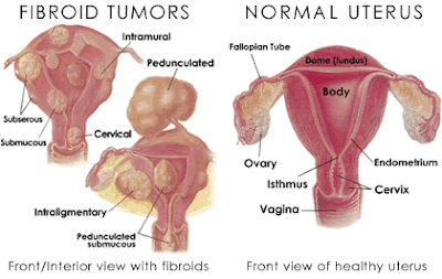 Fibroid Tumors: Natural Treatment & Herbal Remedies | B4tea.com