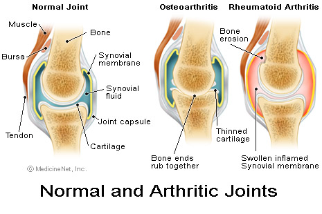 What are some home remedies for arthritis?