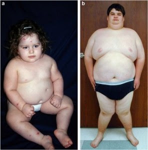 Prader Willi syndrome can be caused in part by a defect in the hypothalamus