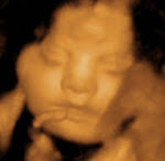 FREQUENT QUESTIONS ABOUT 3D/4D ULTRASOUND
