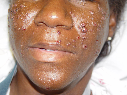 Royal Expressions: Cryptococcosis Gattii: The Meaning, History