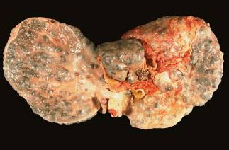 Is liver cancer easy to find in the early stages?