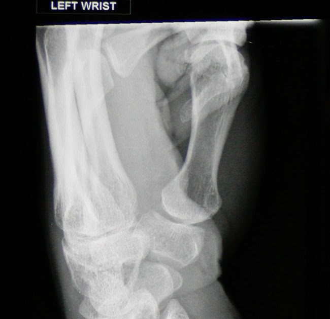Bone Broke? Me Fix!: Distal Radius Fracture