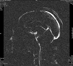 Cine MRI - Connie's Brain