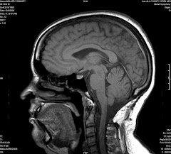 MRI Connie's Brain