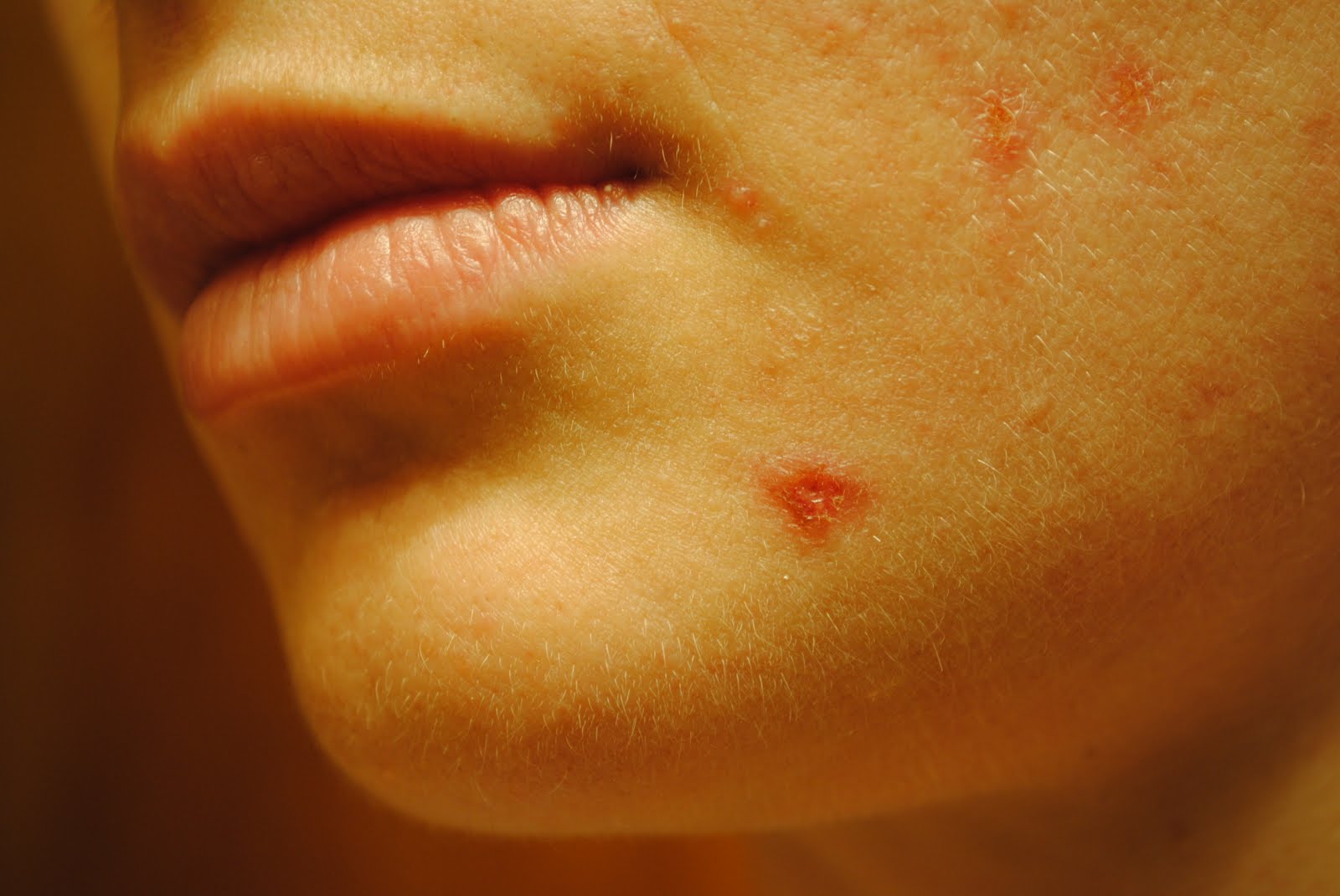 Can Mold Cause Viral Infection at Lewis Mendoza blog