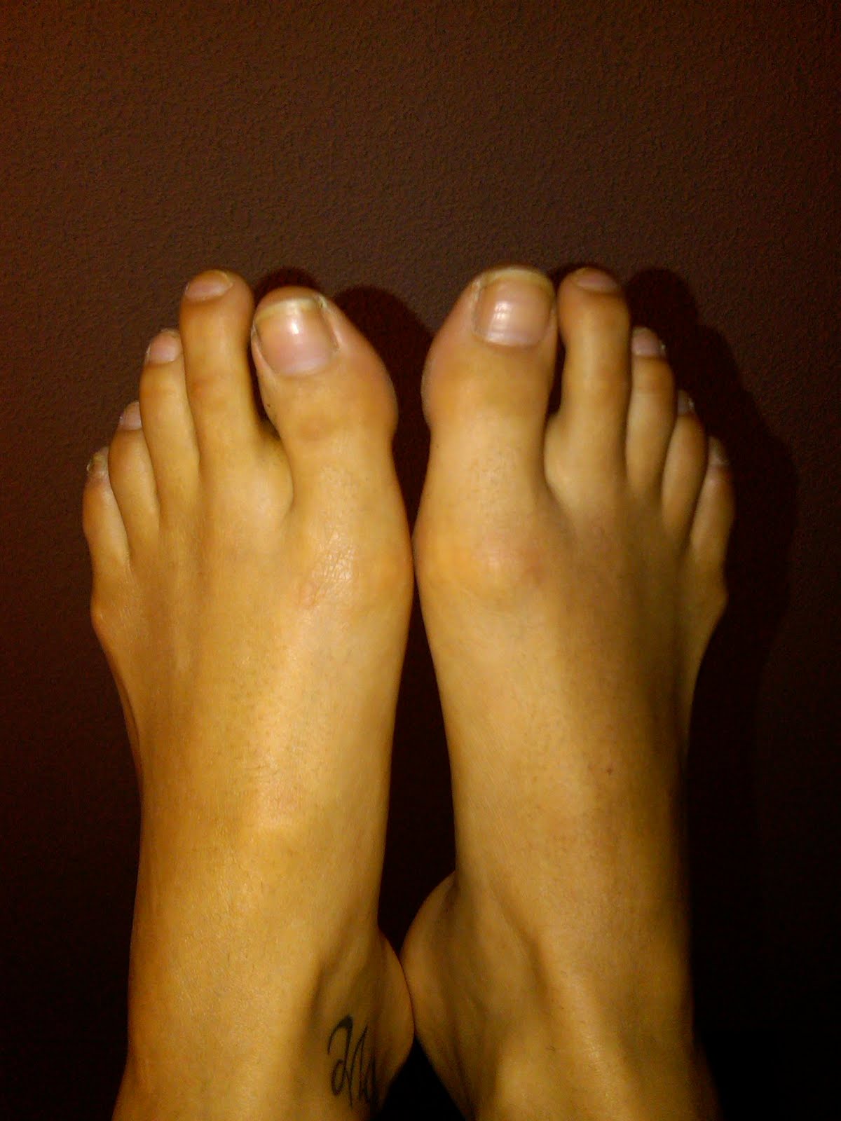 cuticle overgrowth cuticle overgrowth