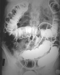 THIS COLON IS CLEARLY SEEN ON THE BE.THE WHITE AREAS ARE BARIUM(CONTRAST) & THE BLACK REGIONS AIR