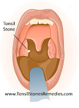 Tonsil Stones and Bad Breath